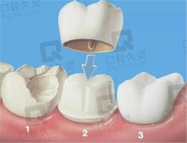 牙冠修复多少钱一颗，一般能用多久？