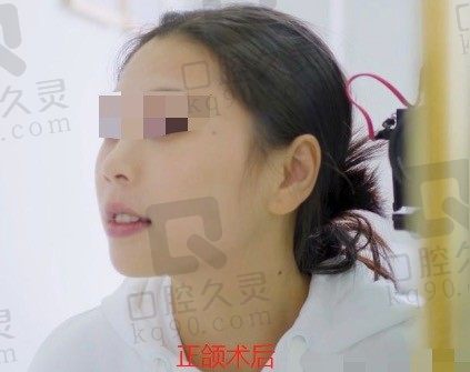 在广州广大口腔做了正颌手术3个月后，改善凸嘴效果明显！