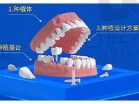 广州穗华口腔半口种植牙套餐16100元起，好牙尽享好口福