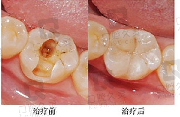 分享我在北京京一口腔医院的补牙经历，补牙价格不贵！