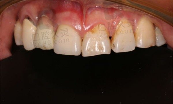 门牙牙断了一半怎么办,看我在深圳明森齿科做的全瓷冠修复