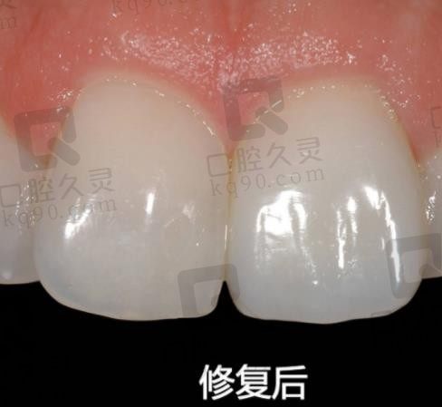 牙齿断裂怎么修复，请看牙友牙冠修复断裂牙齿全过程