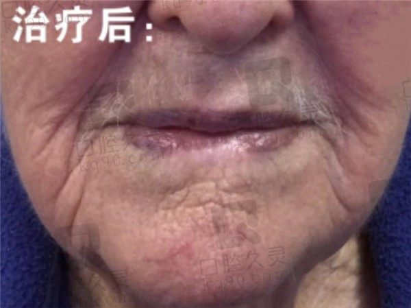 全口牙缺失可以做活动义齿吗,看89岁老人做活动假牙的过程