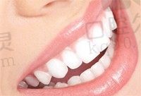 牙齿发黄怎么办？分享我在广州穗华口腔做牙齿美白的经历