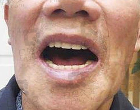 分享老爸在深圳美奥种植牙的经历，唯一遗憾是该早点做