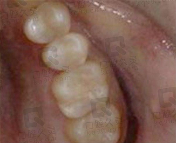 牙齿有个洞补牙疼吗,我在长沙爱思特口腔补牙的经历告诉你