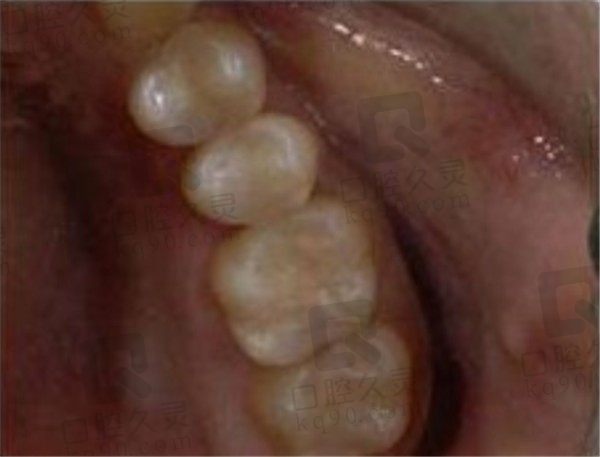 蛀牙不疼但是黑了需要治疗吗，看牙友分享的龋齿补牙范例