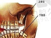 哪种智齿不用拔？看难拔的智齿图就知道要拔的智齿有哪种