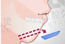 从正常下巴和后缩下巴图对比，看自然方法改善嘴凸可行吗?
