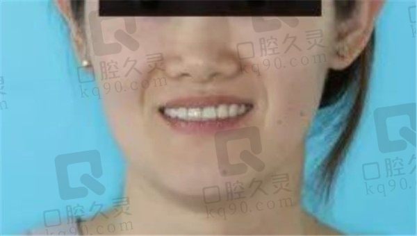 杭州口腔医院牙齿矫正怎么样,看我牙齿地包天矫正前后变化