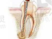 根管治疗就是骗局，医生不会说的根管秘密由我来揭秘
