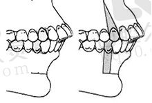 门牙外凸不建议再矫正了是真是假？这有嘴凸整牙前后对比