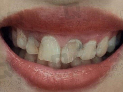 石家庄烤瓷牙就选赵翠彩口腔，我的门牙烤瓷牙图片过程