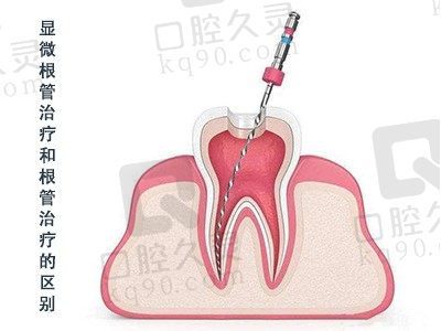 看显微根管治疗和根管治疗区别,分析显微根管治疗有必要吗