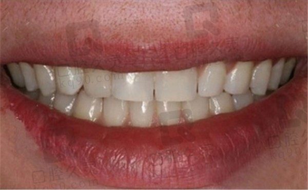 北京瑞泰口腔种植牙怎么样,看牙友分享的单颗,全口植牙实例
