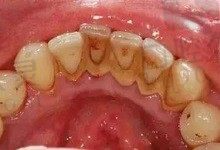 洗牙对牙齿有伤害吗？分享我在石家庄赵翠彩口腔洗牙过程