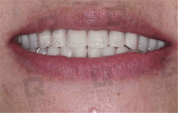 牙龈萎缩能做种植牙吗，请看芜湖美臣口腔全口牙种植范例