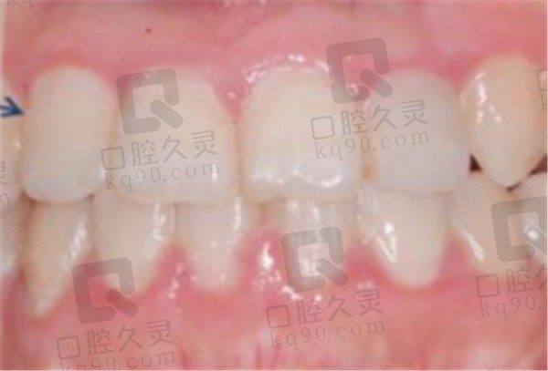 北京科尔口腔牙齿矫正怎么样,请看牙友分享的牙齿矫正案例