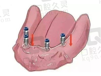 种植牙全固定好还是半固定好？半固定种牙可以不摘下来吗