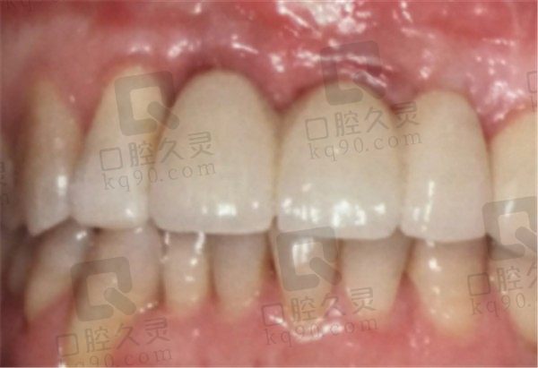 金华婺城口腔医院种植牙怎么样,请看牙友分享的种植牙案例
