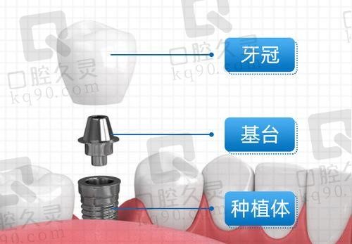 南京美奥口腔种植牙价格并不高,韩国登腾种植牙套餐7000元起