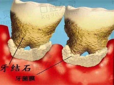 读懂牙结石0度到3度的图，带你判断自己牙结石严不严重