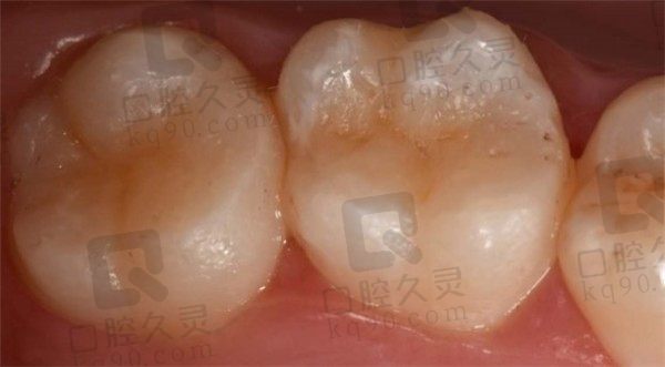 龋齿早点补牙有什么好处，看我北京荷马口腔补牙体验分享