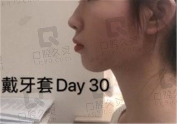 牙齿矫正牙套脸会恢复吗,看我在上海维乐口腔矫正牙30天的变化