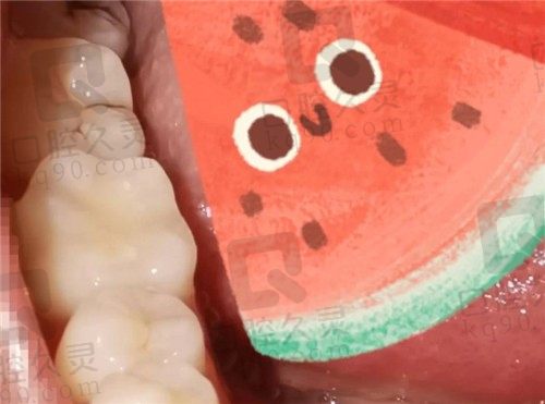 蛀牙牙疼补牙有用吗、看我在郑州金水卓越口腔的补牙过程