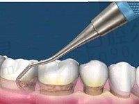 龈下刮治后牙龈还会再生吗？过来人告诉你龈下刮治的利与弊  