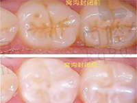 窝沟封闭后更容易烂牙吗？小孩子窝沟封闭的利与弊早知道