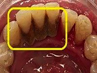 牙结石到什么程度需要洗牙？解答家用牙结石去除器有用吗