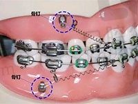 正畸支抗的作用是什么？深度解析整牙什么情况要打骨钉