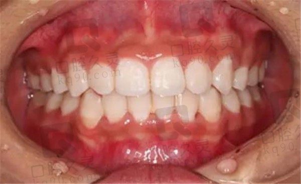 郑州固乐口腔牙齿矫正经历分享，矫正牙一年多牙齿整齐了很多