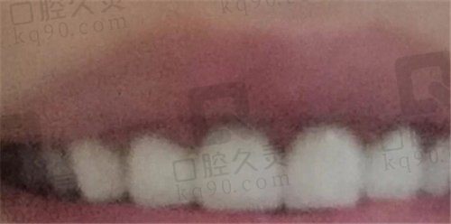 牙坏到什么程度需要做牙冠,看牙友杭州一牙口腔全瓷冠修复真实反馈