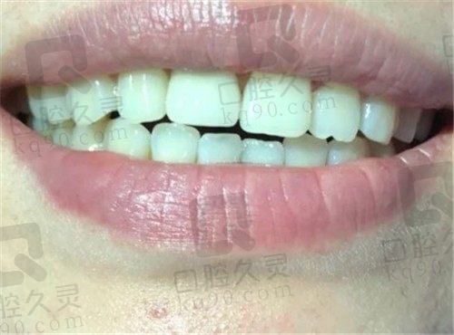 我在晋江修大夫口腔种植了一颗牙,外观、使用上和真牙真没区别