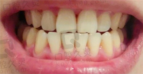 西安中诺口腔洗牙经历分享，洗牙原来是可以预防牙龈萎缩的