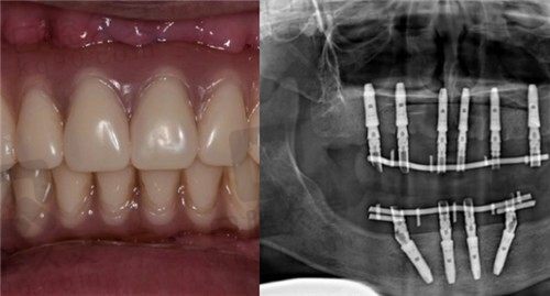 上海鼎植口腔种植牙怎么样，三位60岁以上老人种牙经历告诉你