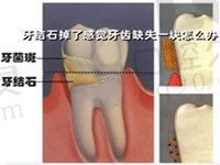 牙结石掉了感觉牙齿缺失一块怎么办？看牙结石去除多少钱