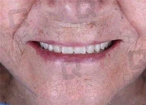 郑州美奥口腔种植牙80岁也能做，不信看婆婆嘴全口牙植牙经历