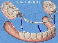 活动义齿可以戴一辈子吗？为什么医生不建议戴活动义齿呢