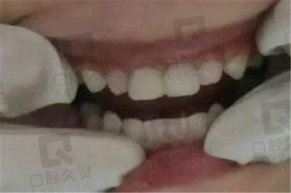 从洛阳维乐口腔儿童乳牙龋齿修复经历上看：儿牙龋坏要不要管