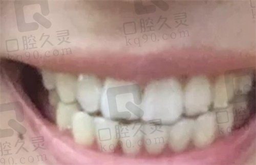 万州牙博士口腔矫正怎么样，请看我金属自锁矫正牙齿一年的经过