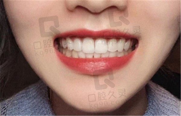 上海大唐口腔门诊部牙齿美白怎么样，看过牙友的牙齿美白过程就明了