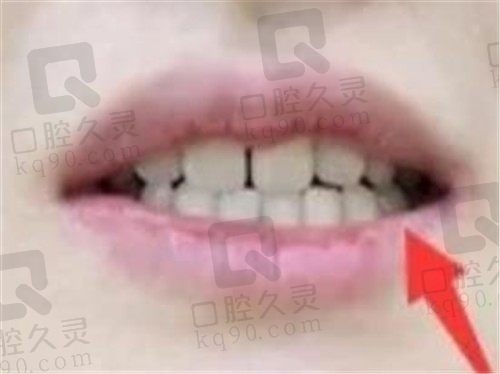 上海薇琳口腔种牙怎么样，从我的种植牙品牌、价格、时间、结果上来看