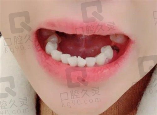 杭州植得口腔种植牙亲身感受分享：种牙当天用真棒！