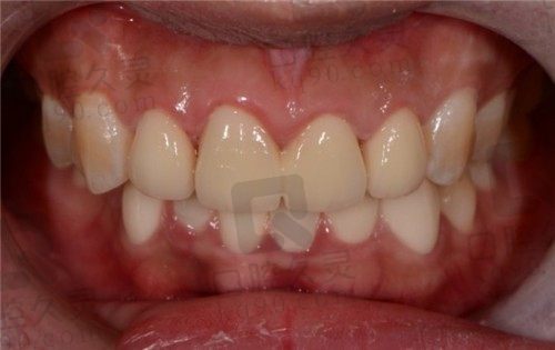 牙齿太短了怎么办，这位牙友在长沙美奥做的牙冠延长术已回答