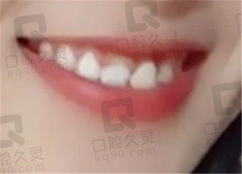 重庆众植博仕口腔探店分享：医院种植牙做的真不错