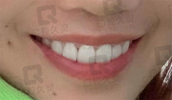 哈尔滨松北悦牙口腔怎么样，网友做了金属自锁托槽后不要太好看