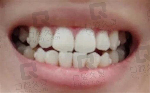 北京劲松口腔矫正牙亲身经历分享，变美做隐形矫正真的很靠谱